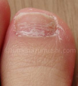 画像 足の爪に白い線が入ってる場合の原因と対処法 爪トラブル対策 Com